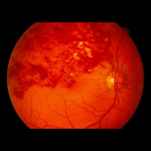 Branch Retinal Vein Occlusion