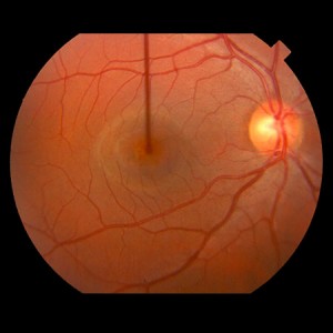 Central Serous Retinopathy